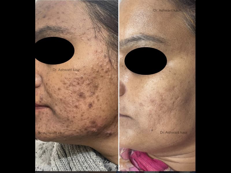 Acne & Scar Treatment