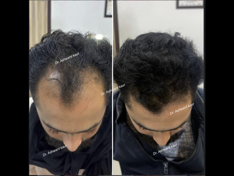 Hair Restoration & PRP
