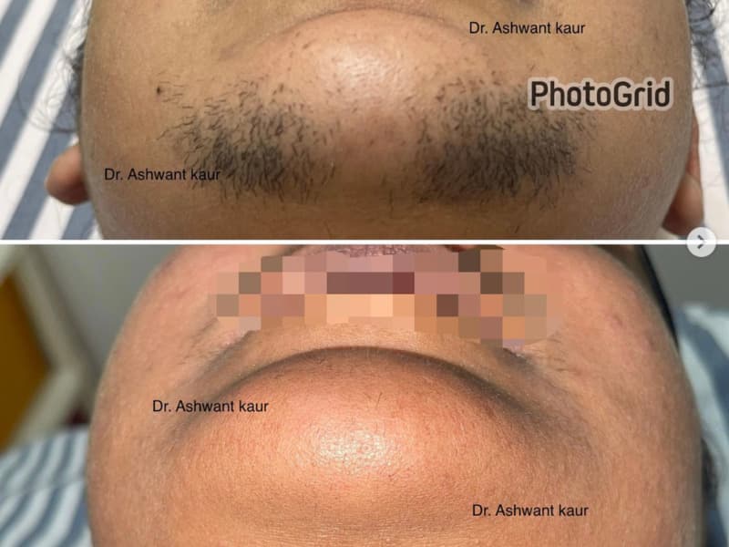 Laser Hair Removal