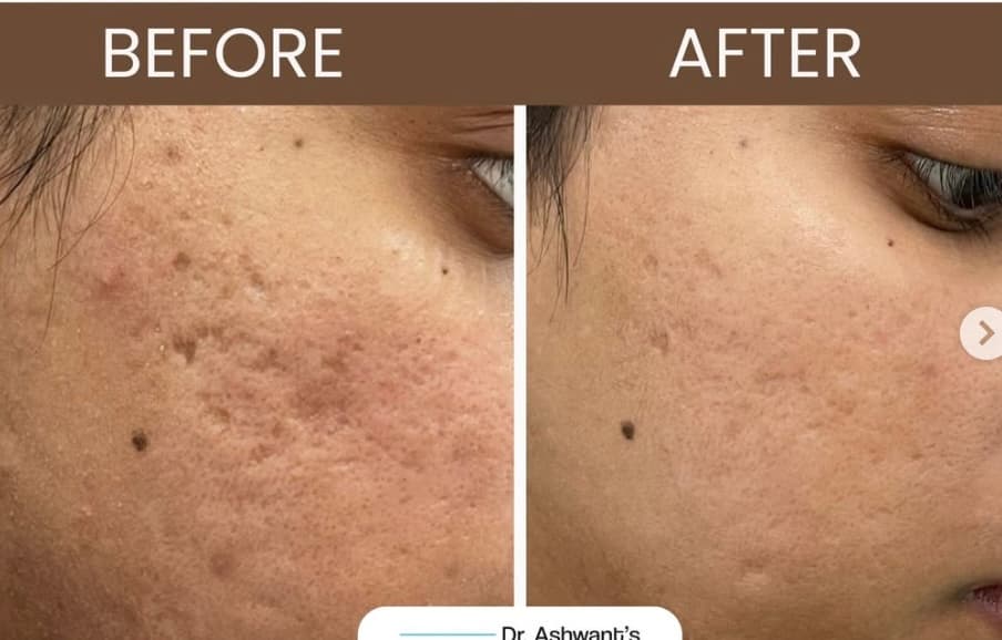MNRF Treatment